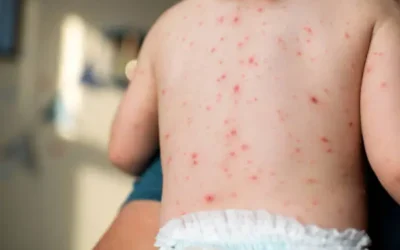 Sinaloa ha presentado 951 casos de varicela en el año: Prevención y Promoción de la Salud
